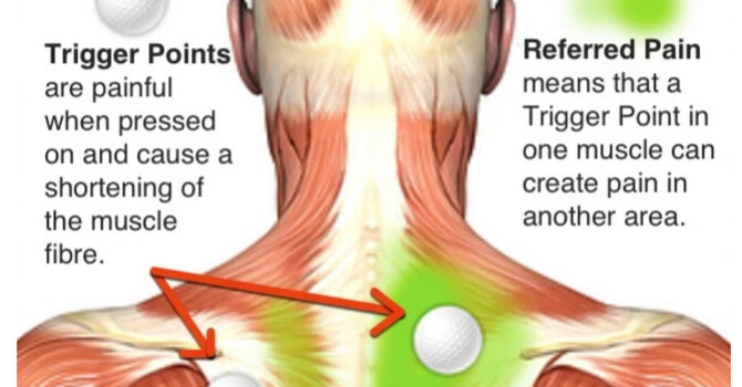 Understanding Trigger Points: Causes, Symptoms, and Effective Treatments image