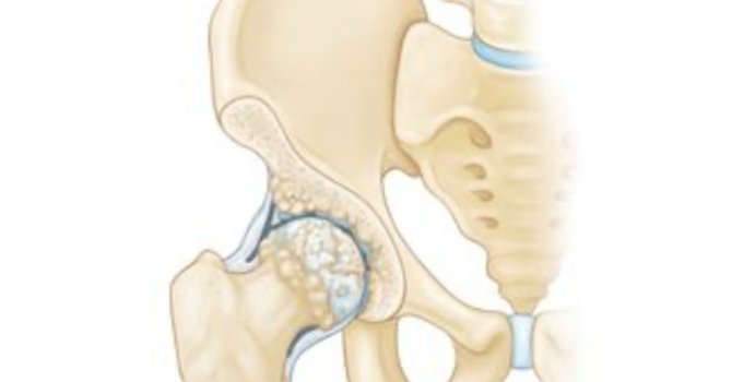 What's Going On When Your Hips Are Making Noise? image
