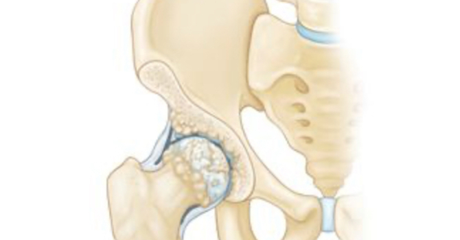 What's Going On When Your Hips Are Making Noise? image