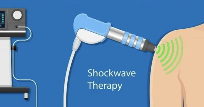 What is shockwave therapy? What is it used for?  image